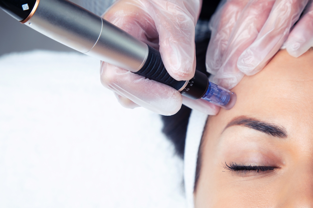 Beneficios del Dermapen: piel firme, luminosa y sin arrugas